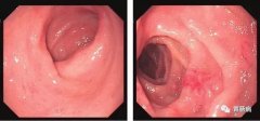 萎縮性胃炎不可怕，只要