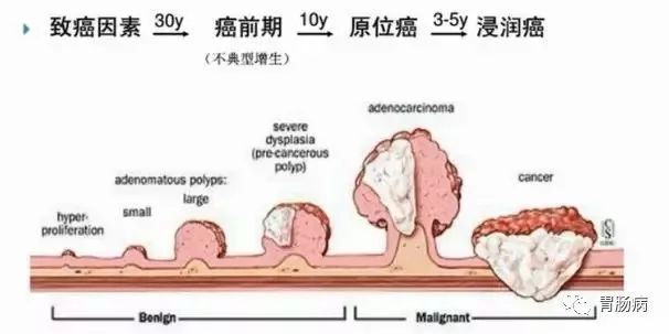 體檢查出腸息肉一定要切除！ 95%腸癌由它演變而來